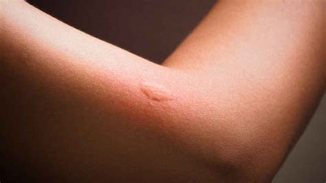 picadura de mosquito alergia-4